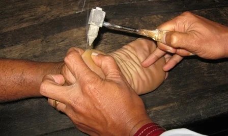 treatment